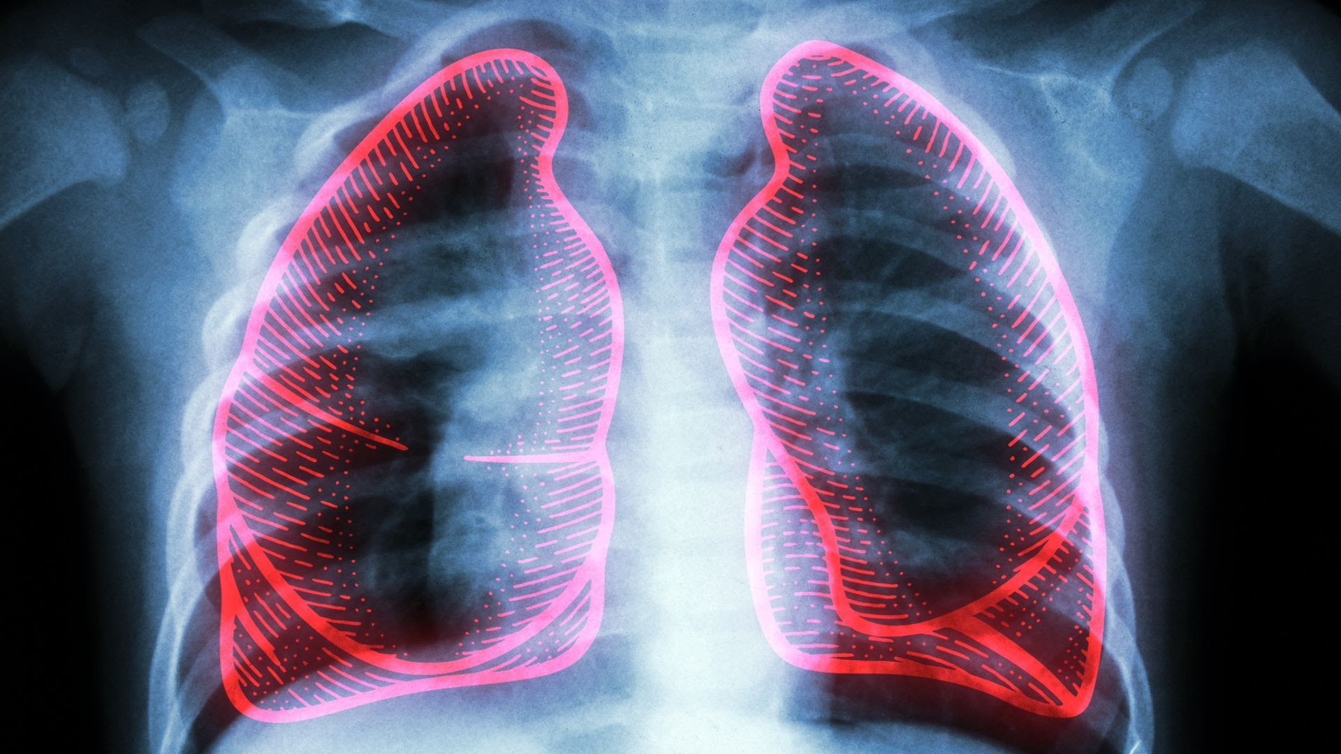 Illustration of a child's xray showing red glowing lungs.