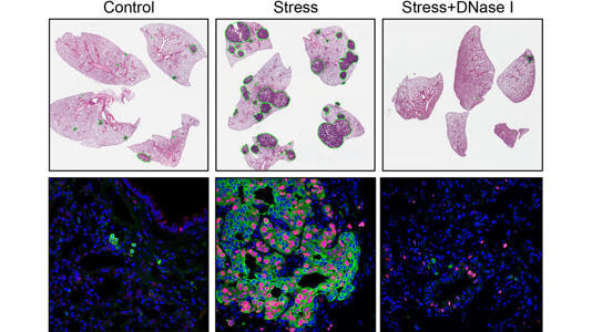 Cancer spread faster and more furiously in stressed mice (middle column) than in a control group (left column). By comparison, cancer cells in stressed mice treated with an enzyme called DNase I (right column) were largely non-proliferating, and the treatment caused a significant reduction in stress-induced metastasis. Credit: Egeblad lab/Cold Spring Harbor Laboratory