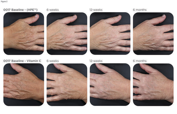 A Comparative Study of Two Topical Treatments for Photoaging of the Hands