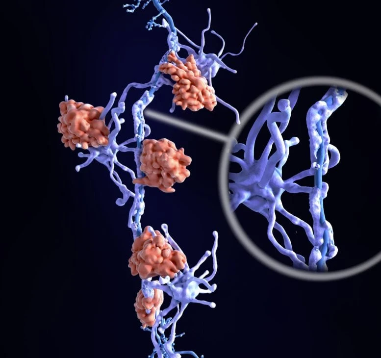 Multiple Sclerosis Neuron