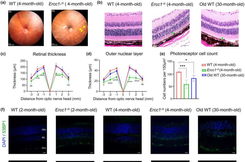 DNA damage is key factor in age-related macular degeneration