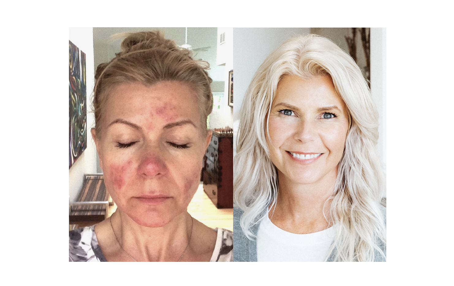 Founder Lisa Brill before photo on the left of red skin, acne, ii=nflammation, and upset skin. On the right a clear and even complexion. t