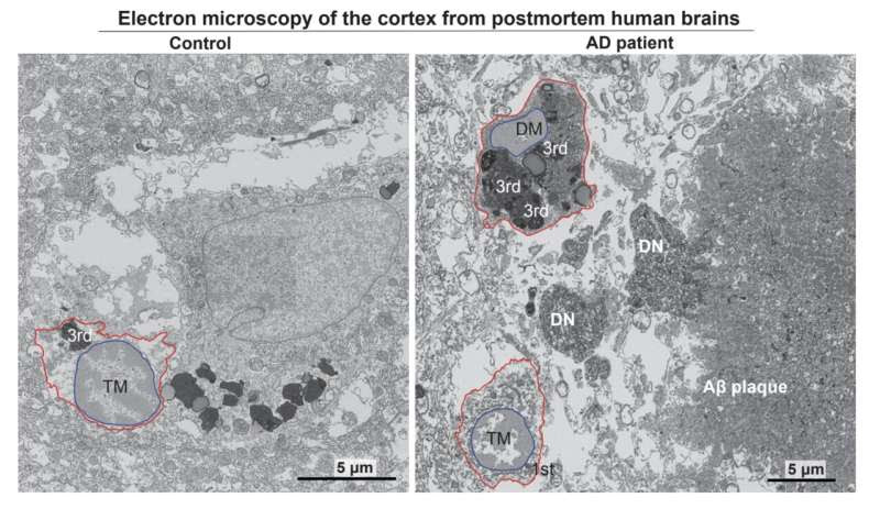 New research identifies key cellular mechanism driving Alzheimer's disease