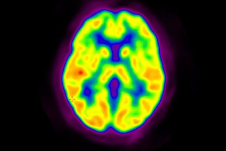 Positron Emission Tomography (PET) Brain Scan