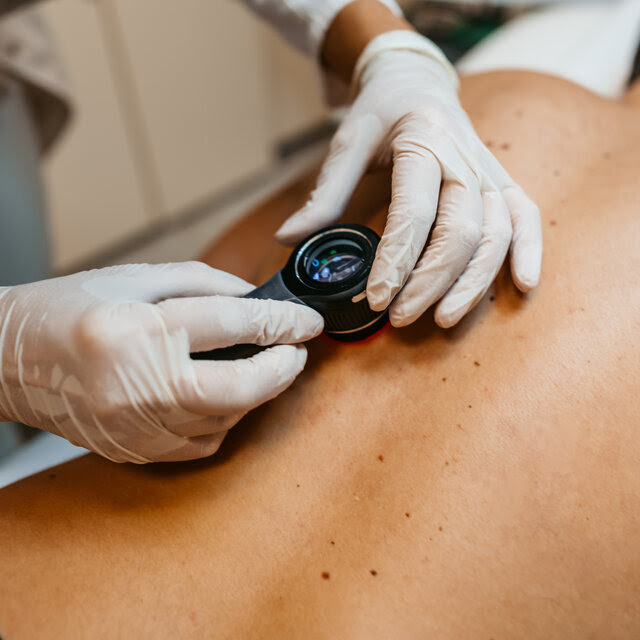 A doctor examines a birthmark on the back of a patient lying face down on an exam table.