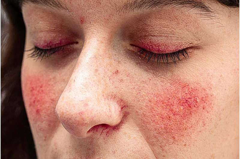 FDA approves emrosi for rosacea in adults