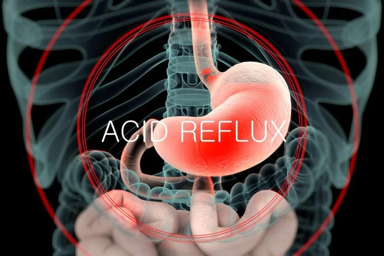 Acid Reflux