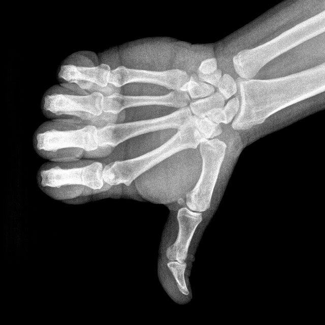 An X-ray of a hand in the shape of a thumbs down. 