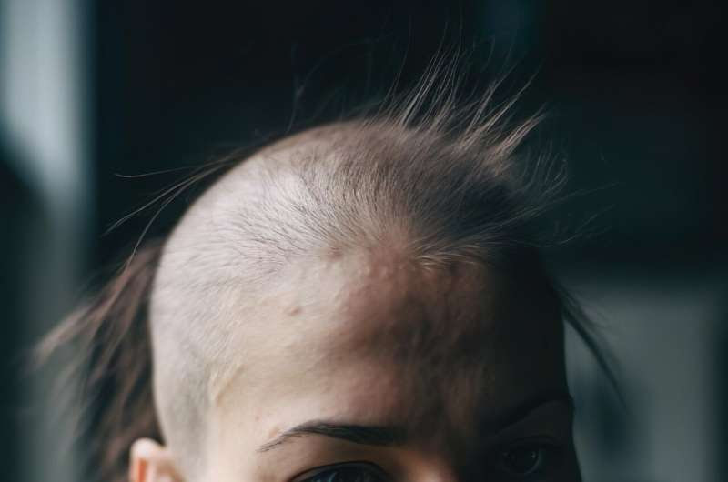 alopecia