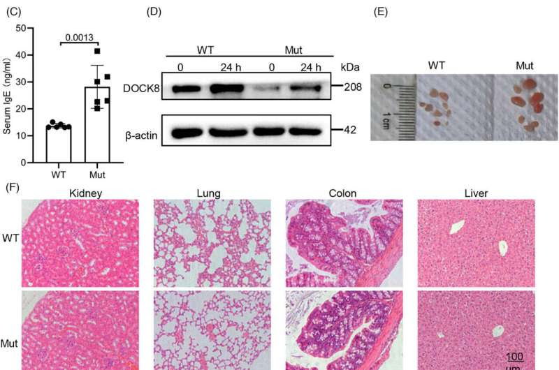 DOCK8 mutation disrupts helper T cell differentiation via glycolytic pathway regulation