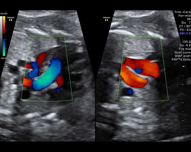 4-Fetal-cardiac