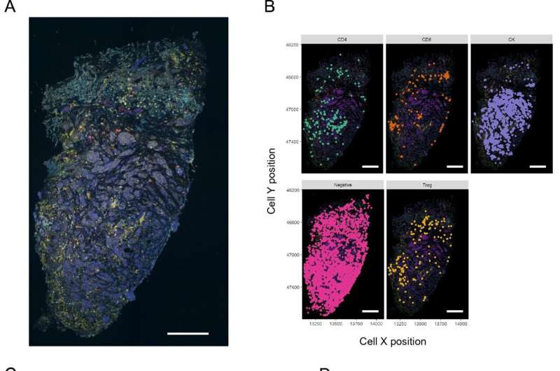 New 'explant' technique predicts a tumor's responsiveness to breast cancer treatment