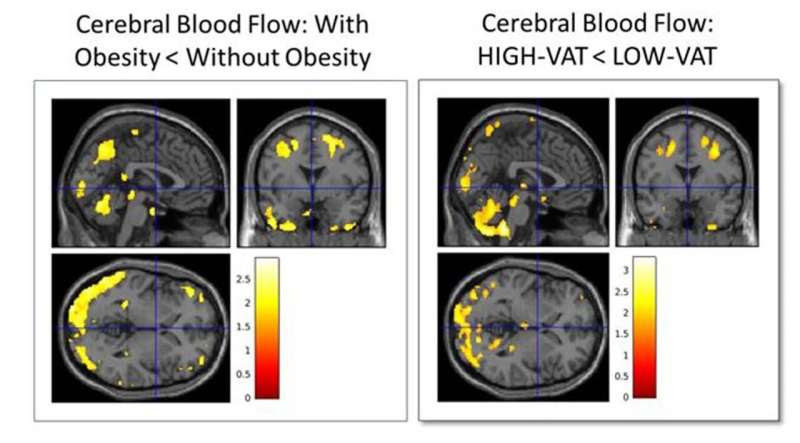 Hidden fat predicts Alzheimer's 20 years ahead of symptoms