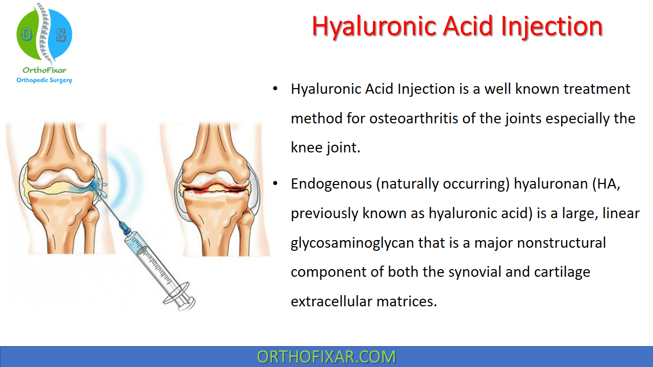 Diagram of hyaluronic acid injection into knee joint