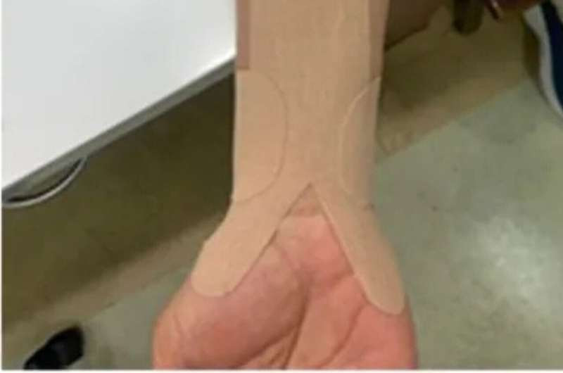 Kinesio taping may represent a new conservative therapy for some carpal tunnel patients