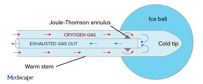 photo of Cryoneurolysis probe