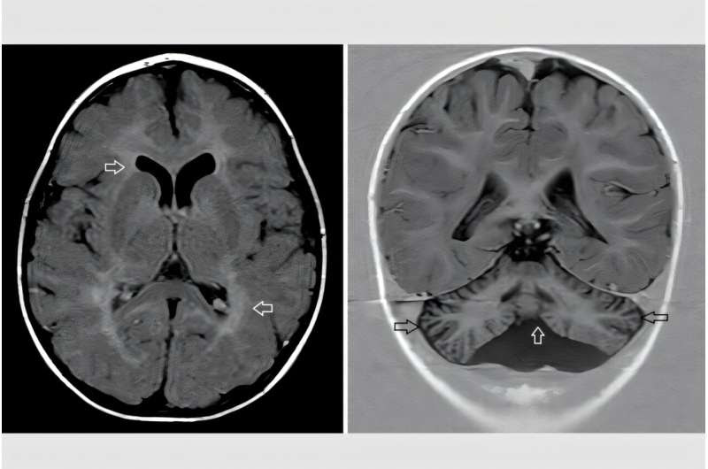 Researchers solve medical mystery of neurological symptoms in kids