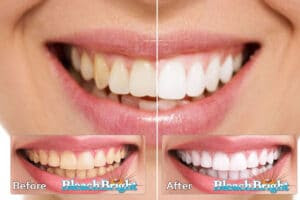 Bleach Bright Teeth Whitening Before After NJ