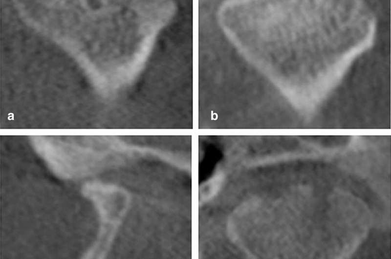 AI deep learning model can diagnose symptoms of joint diseases early and with high accuracy