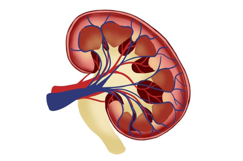 Kidney stones