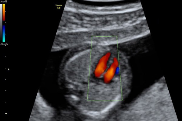 1-4.16W_fetal_heart_color