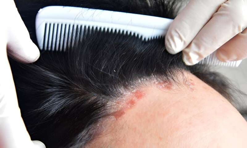 Tacrolimus microemulsion has good efficacy, safety for scalp psoriasis