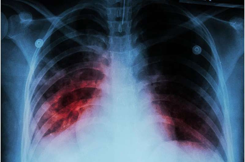 Once again, tuberculosis becomes world's top infectious disease killer