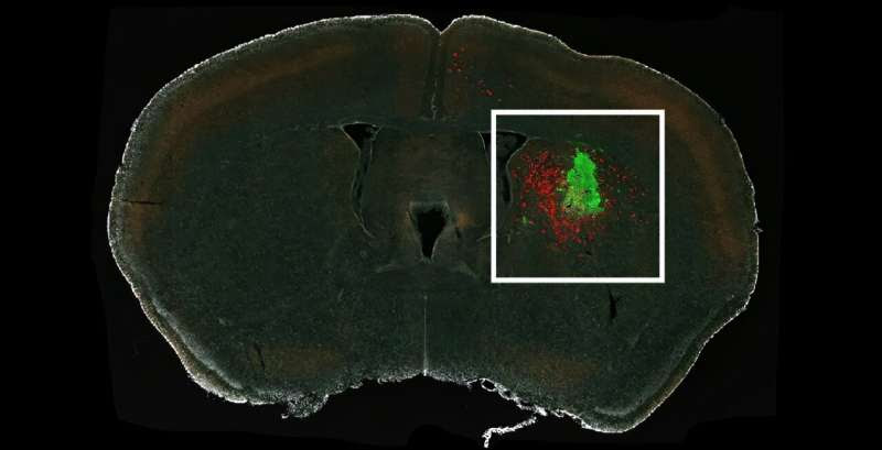 Why Do Gliomas Tend To Recur in the Brain?