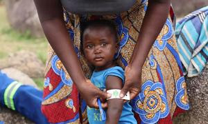 Un niño de Zimbabue es sometido a pruebas de desnutrición.