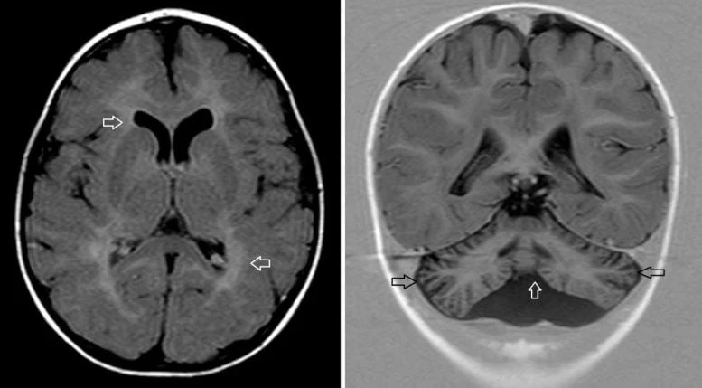 Brain Scans of Patient With Genetic Disease Caused by CCT3 Variants