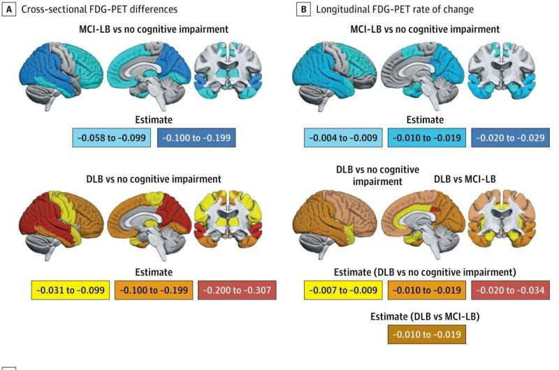 Brain degeneration in dementia with Lewy bodies begins early