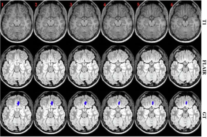 Identifying focal cortical dysplasia lesion from magnetic resonance images