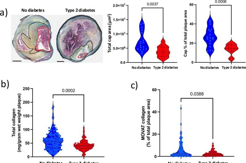 A new explanation for dangerous atherosclerotic plaques in type 2 diabetes