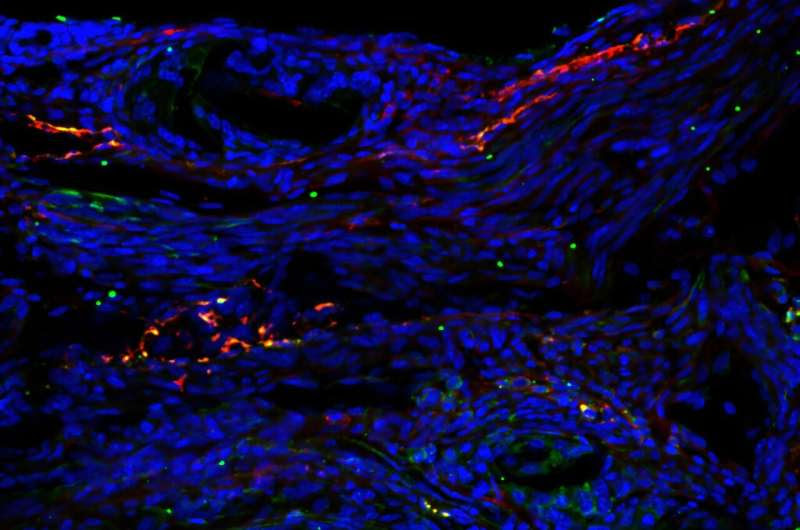 Hidden interactions driving endometriosis discovered in neuroimmune communication