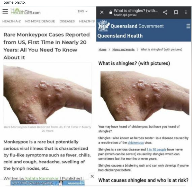 Hypocrite News media using exact same photo for both Monkey Pox and Shingles.