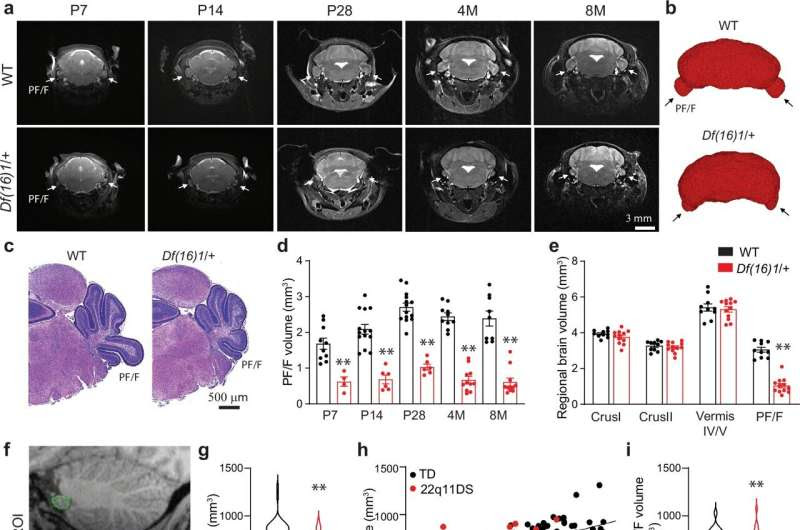 Genetic risk for schizophrenia linked to a malformed skull