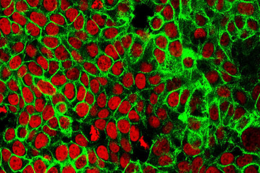 Human colon cancer cells with the nuclei stained red. AP