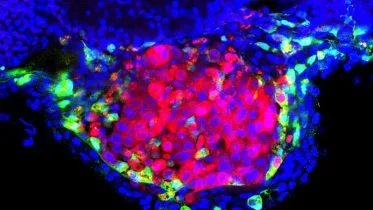 Human Bladder Tumor Surrounded by Zebrafish Macrophages