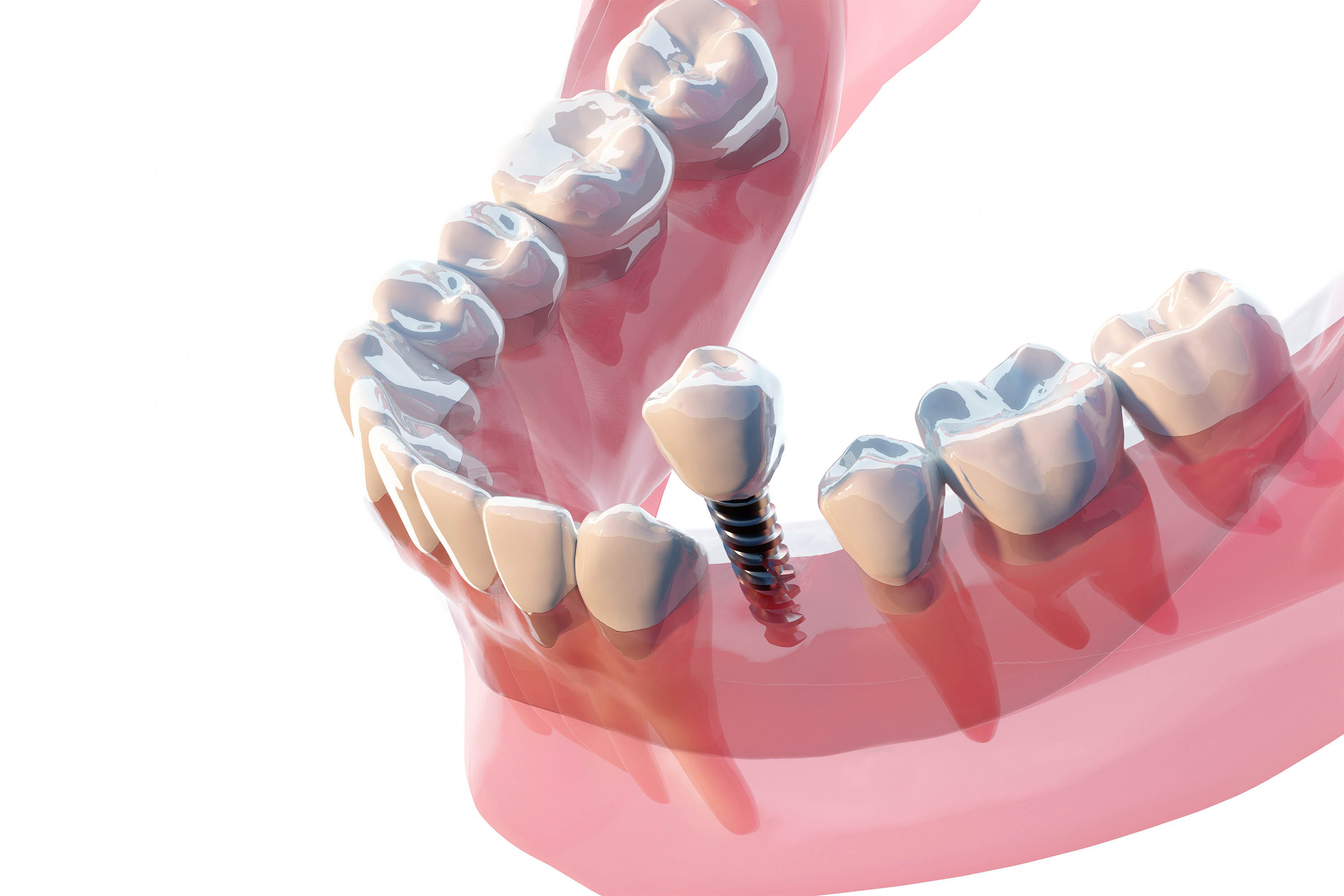 A digital rendering of a dental implant being inserted.