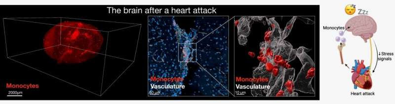 After a heart attack, the heart signals to the brain to increase sleep to promote healing