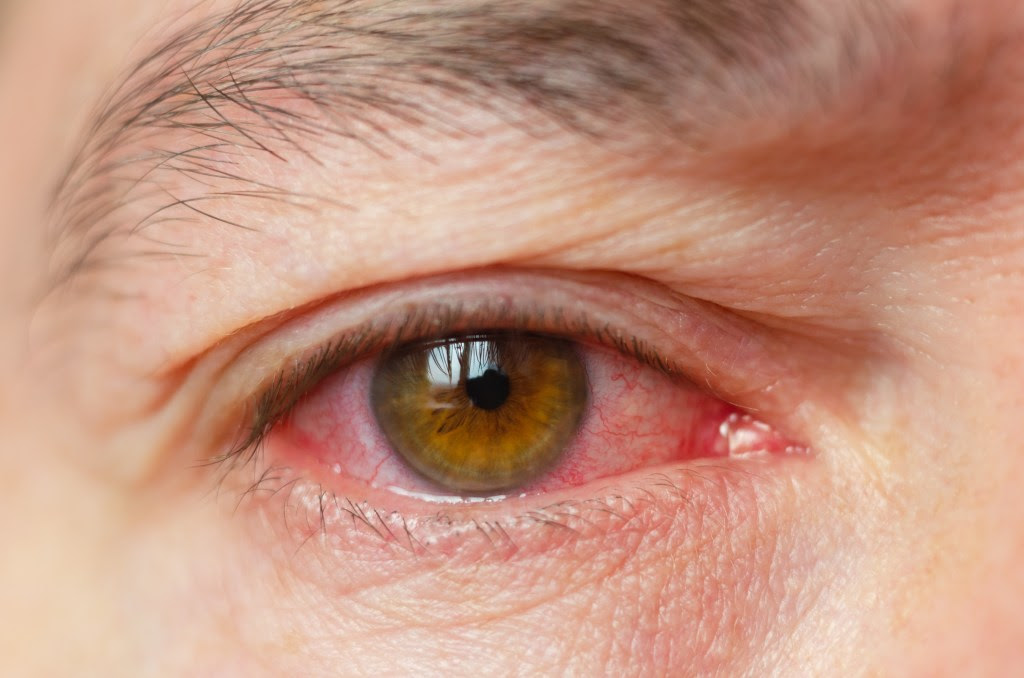 Redness, itchiness, swelling and a gritty feeling are just some of the symptoms of pink eye. Here is a close-up shot of bloodshot eyes.