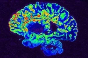 IA leads the charge against multiple sclerosis