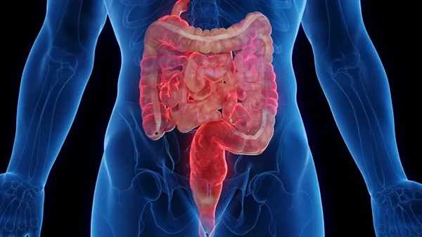 An illustration of intestines affected by Crohn's disease highlighted in pink in a blue body