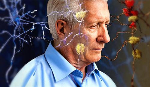 4648 8 AlzheimerHNM