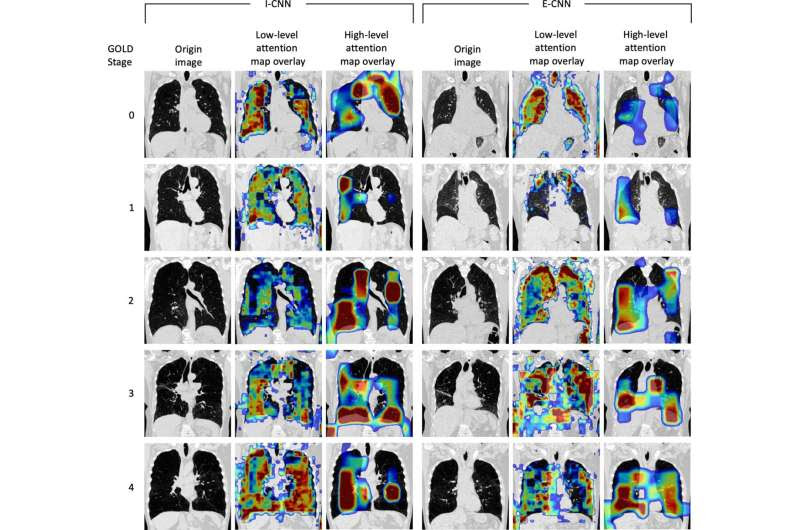 Deep learning model accurately diagnoses COPD