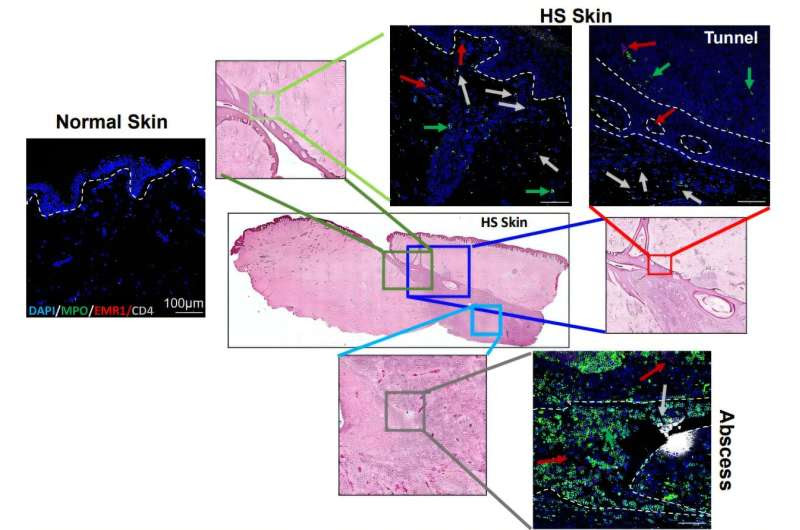 Study reveals potential new treatment option for people with debilitating skin condition