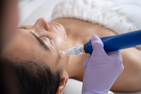 Woman receiving a micro-needling treatment