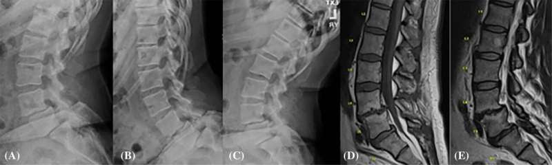 Does the gut microbiome affect spine health?