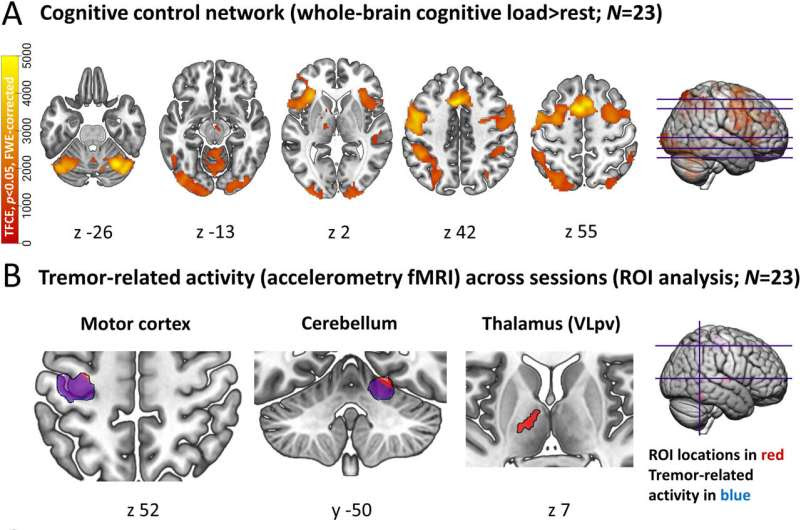 Propranolol reduces tremors in Parkinson's disease