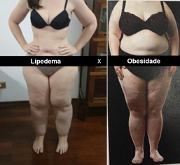 Amanda Djehdian está tratando lipedema, gordura acumulada nas